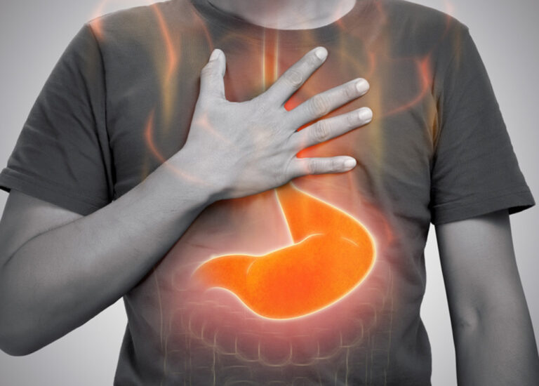 Burning in the Chest? It Might Be GERD – Not Just Acidity